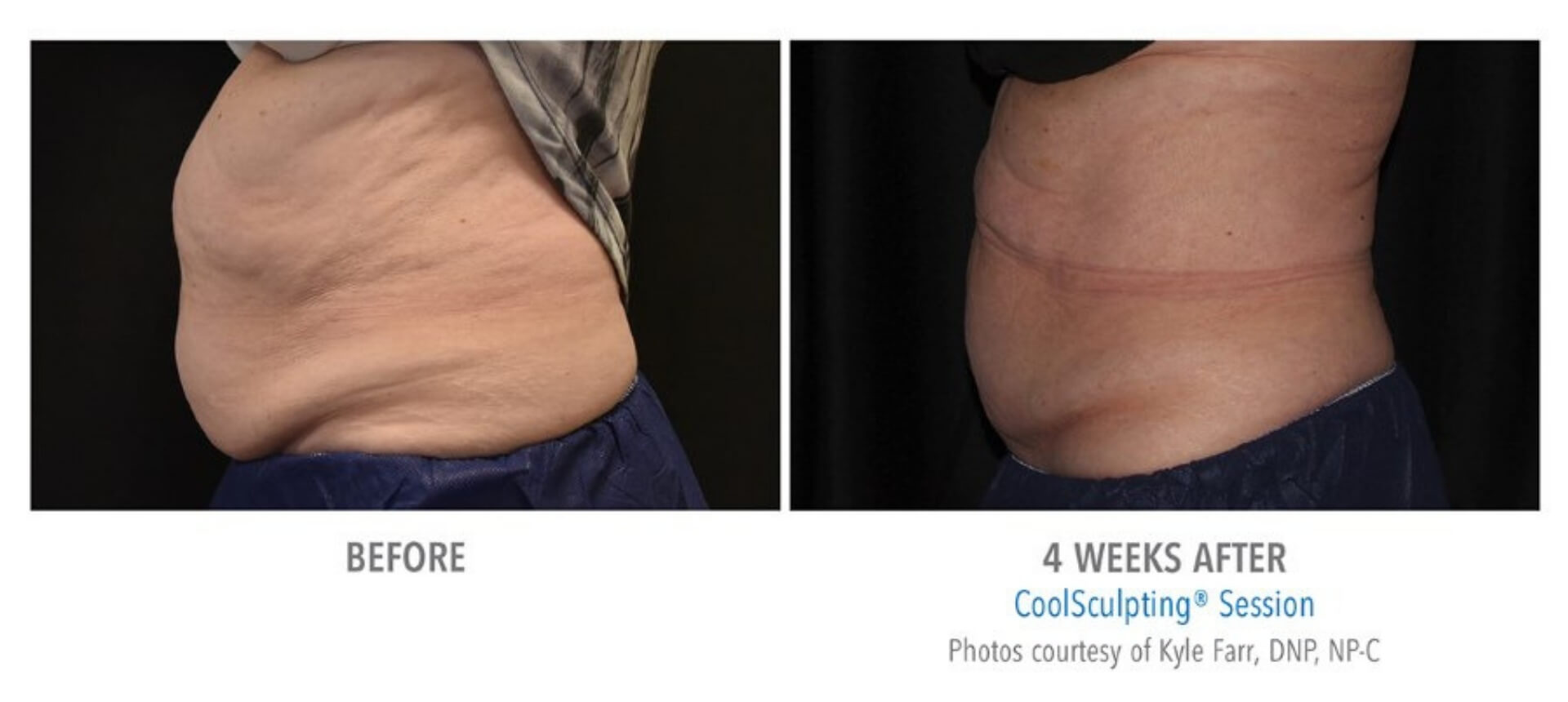 Coolsculpting Freeze Fat In Randolph Nj Fda Cleared Non Invasive 2753