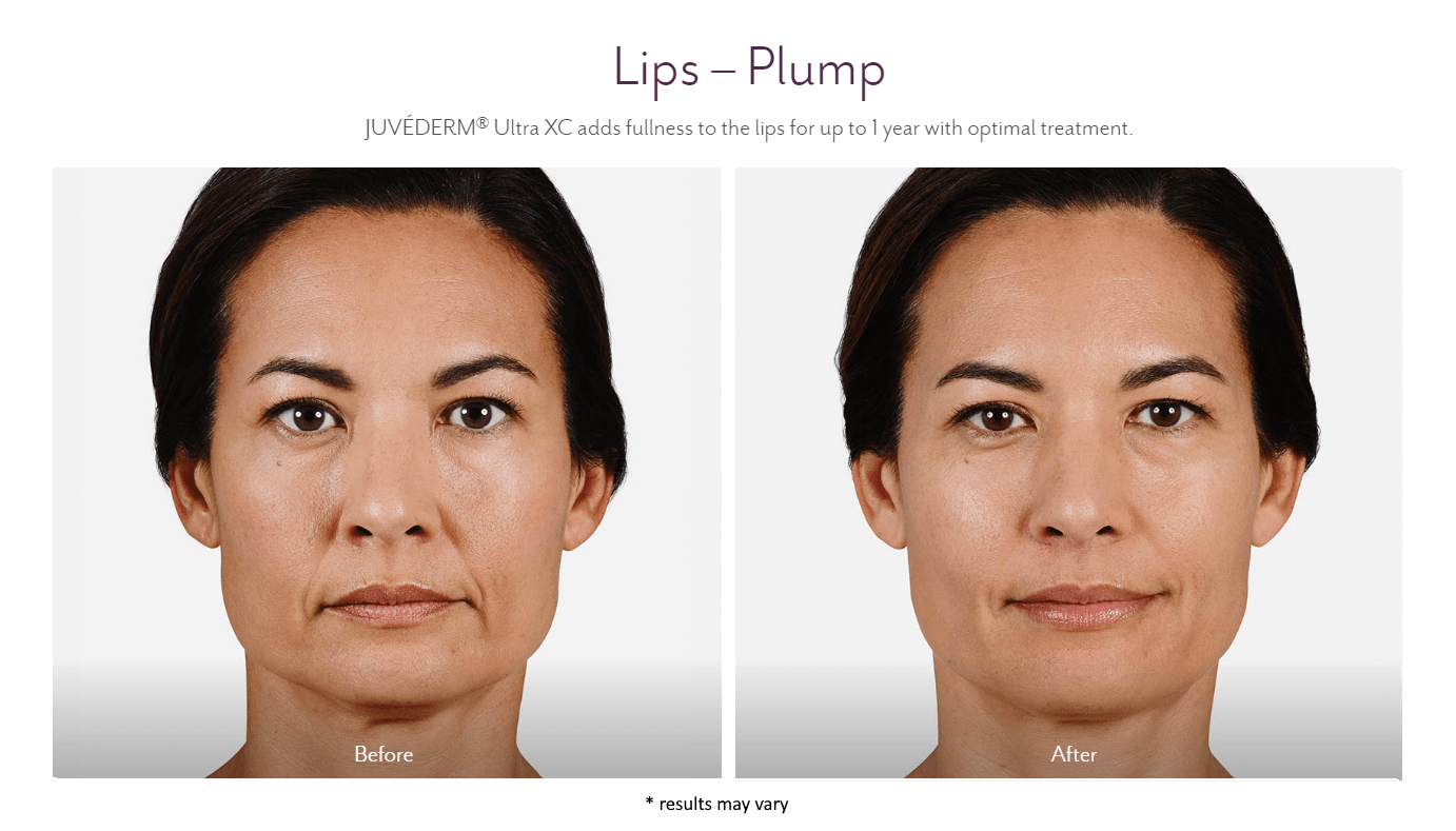 juvederm_before_and_after_6
