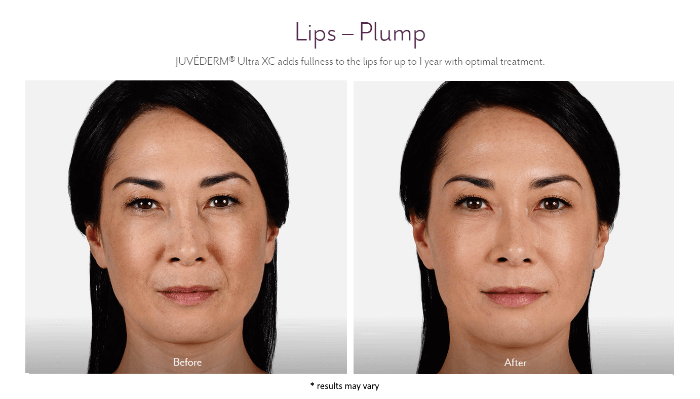 juvederm_before_and_after_8
