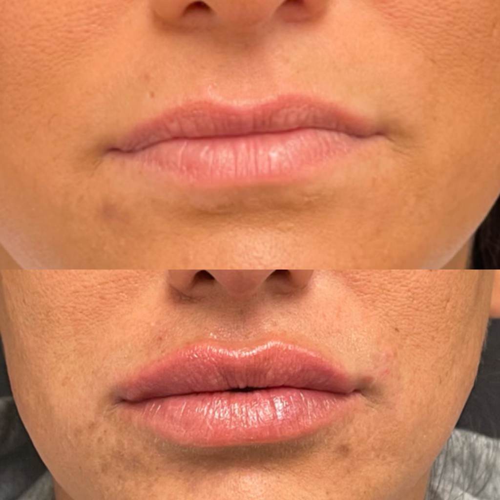 Lip filler before and after at Image Revolution in Randalph NJ