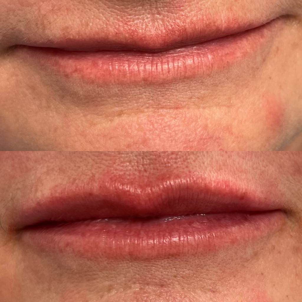 Lip filler before and after by Image Revolution in Randolph NJ