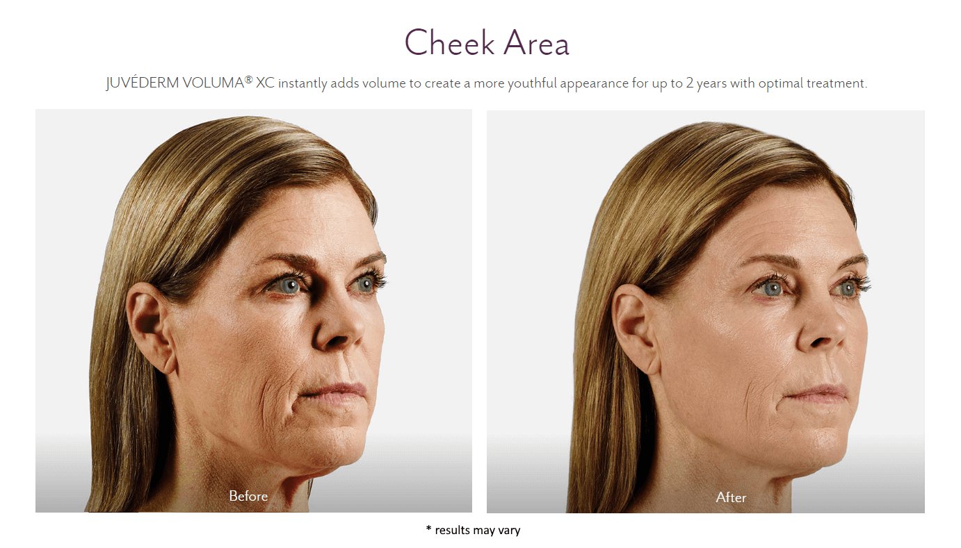 juvederm_before_and_after_10